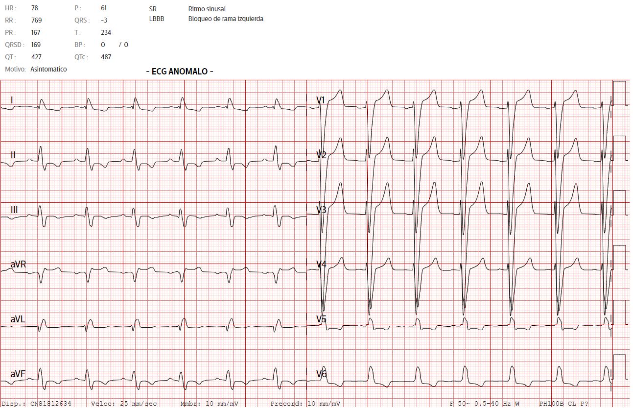 Electrocardiograma - RADELEC